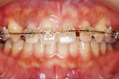 前歯のみの部分矯正治療