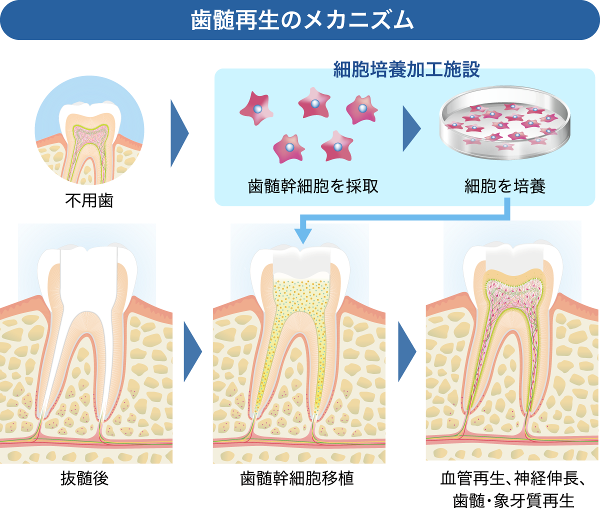  歯髄再生治療とは？歯の神経を再生する治療をやさしく解説
